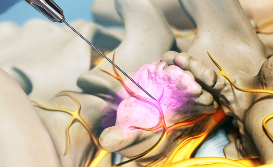 Radiofrequency Nerve Ablation Radiofrequency Ablation Procedure DYMFBR Radiofrequency Nerve Ablation Radiofrequency Ablation Procedure DYMFBR